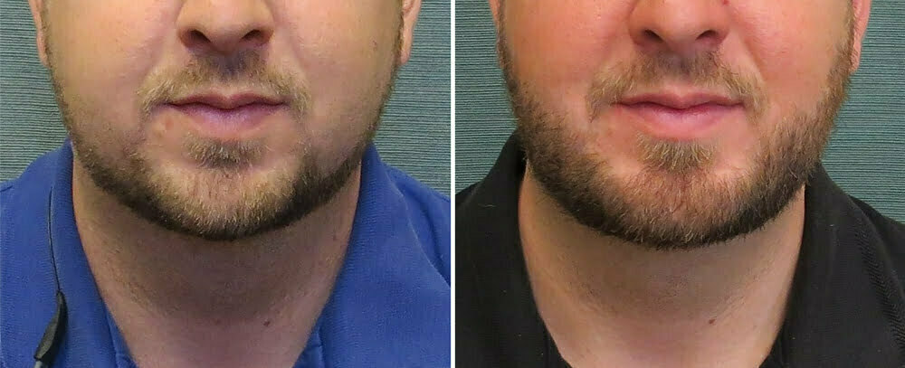 Neck Liposuction G164