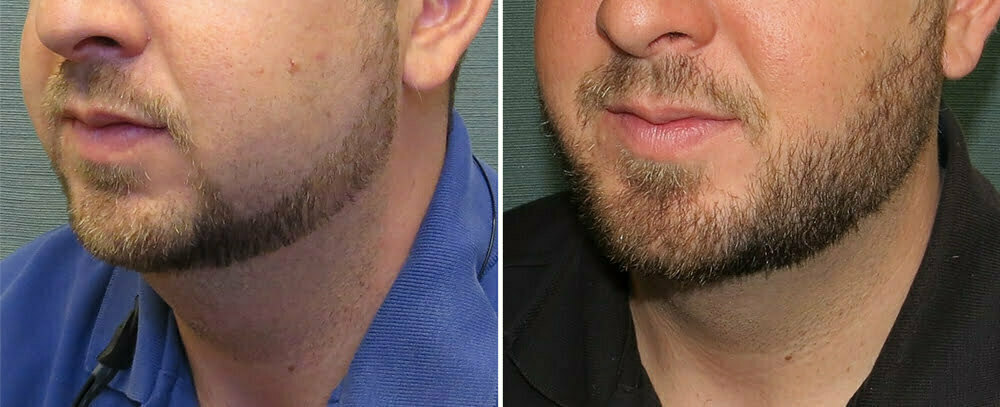 liposuction-neck-64b-right-kirby