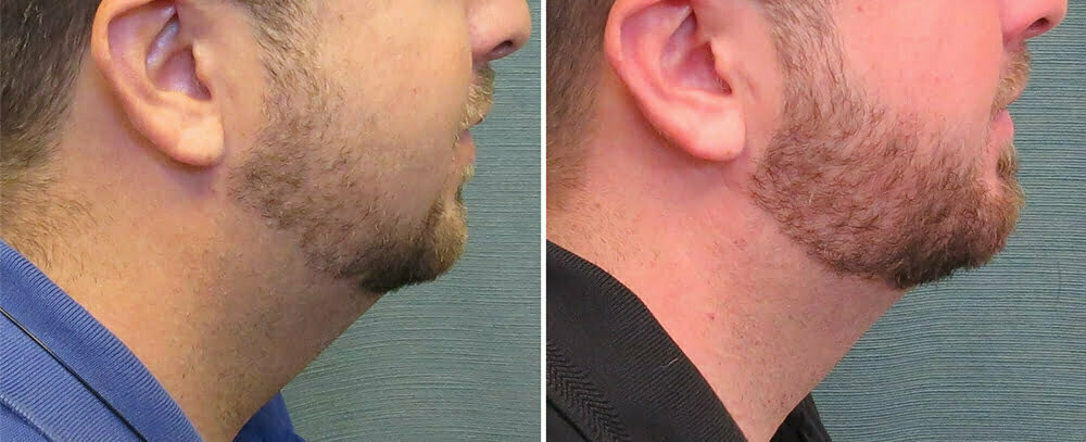 liposuction-neck-64c-kirby