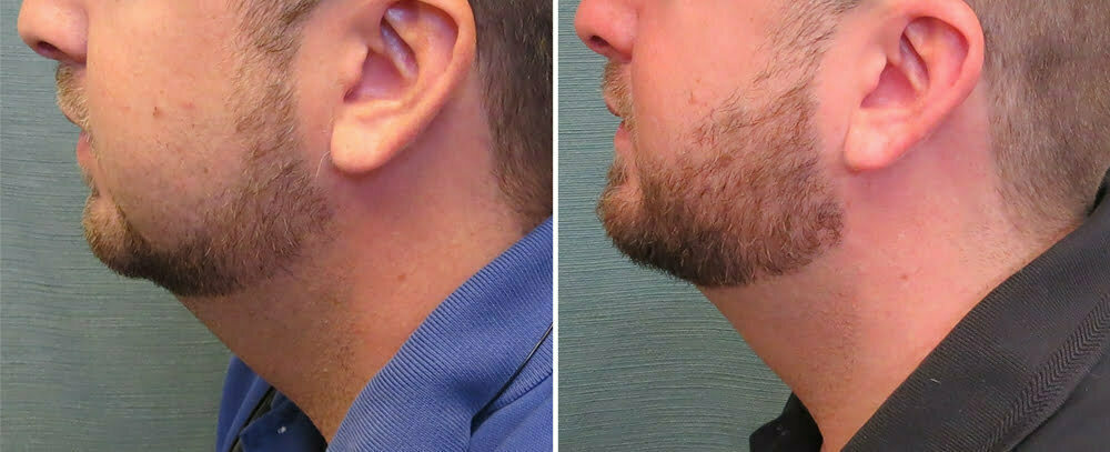 liposuction-neck-64c-right-kirby