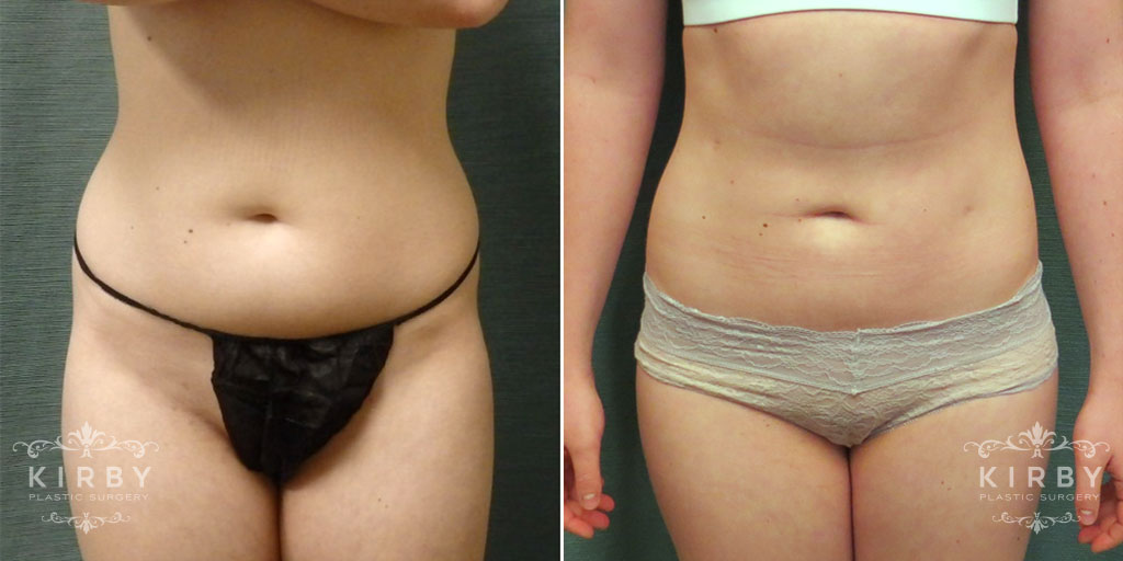 Liposuction Patient G1118