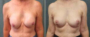 revision-breast-augmentation-with-lift-106a-kirby