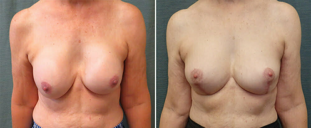 Breast Implant Exchange G1106