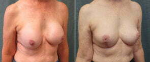 revision-breast-augmentation-with-lift-106b-kirby