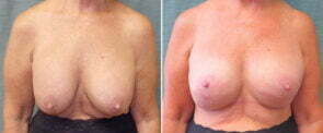 revision-breast-augmentation-with-lift-110a-kirby