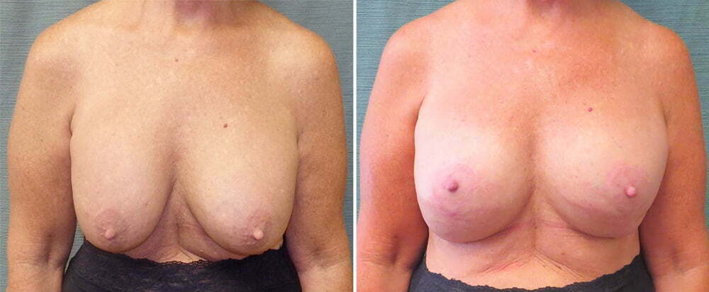 Breast Implant Exchange G1110
