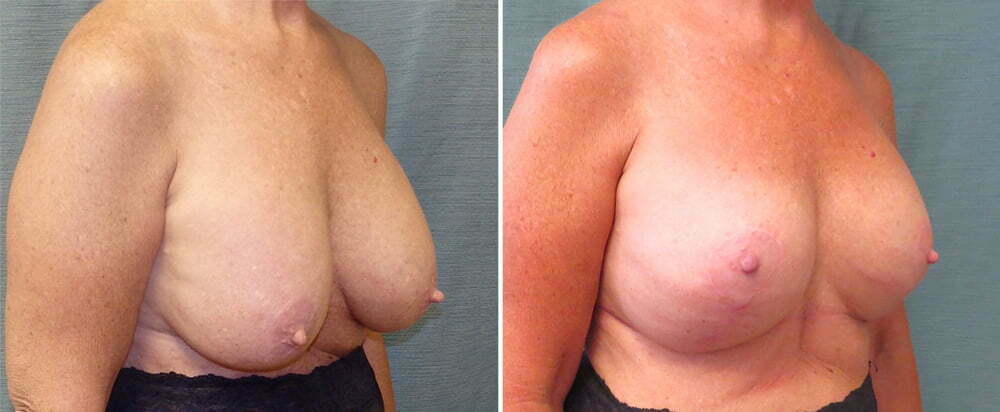 revision-breast-augmentation-with-lift-110b-kirby