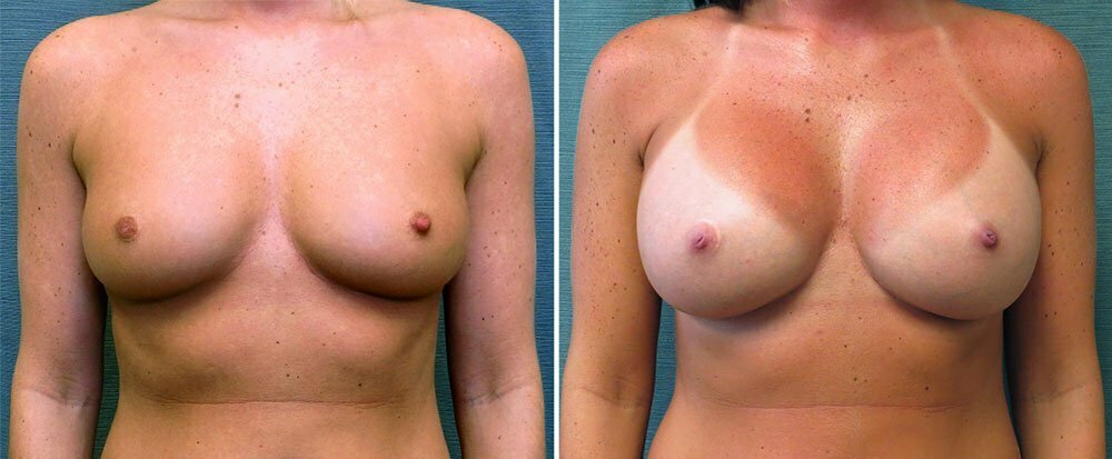 Breast Augmentation G1114