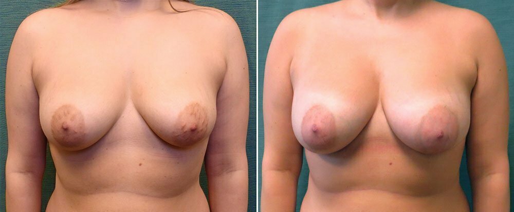 Breast Augmentation G1126