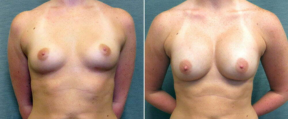 Breast Augmentation G117
