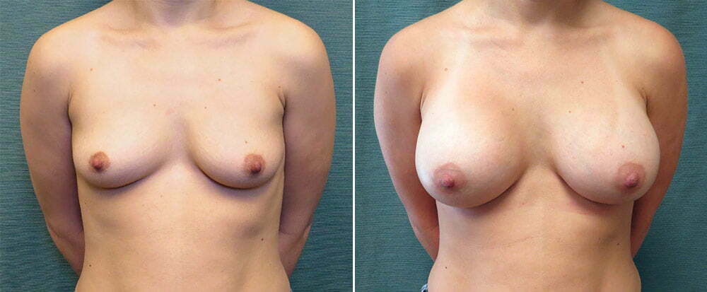 Breast Augmentation G118
