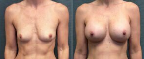 breast-augmentation-284a-kirby