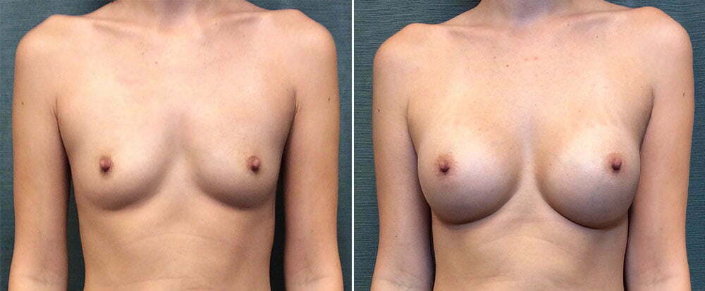 Breast Augmentation G1317