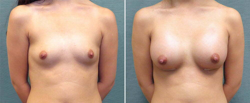 Breast Augmentation G131