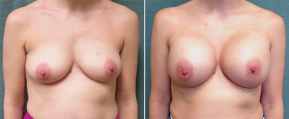 Breast Augmentation G1111