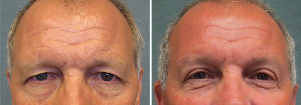 Before and After Brow Lift & Upper Blepharoplasty (Eyelid Lift)