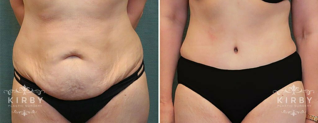 Tummy Tuck Patient G140