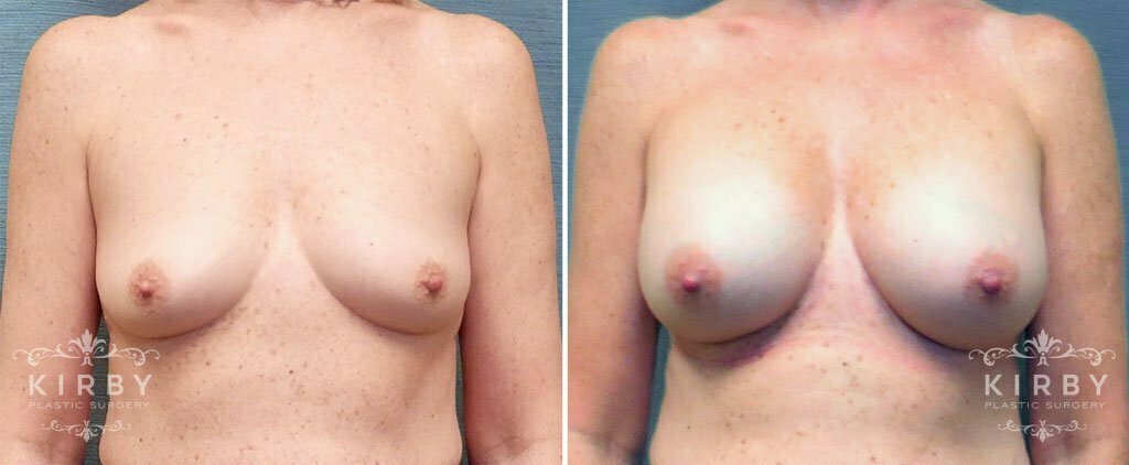 Breast Augmentation G1159