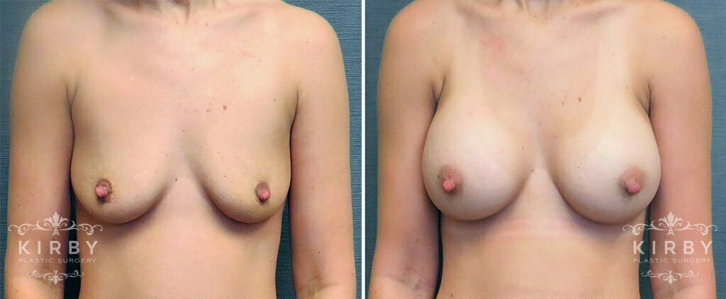 Breast Augmentation G1205