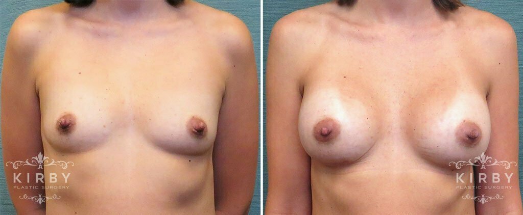 Breast Augmentation G150