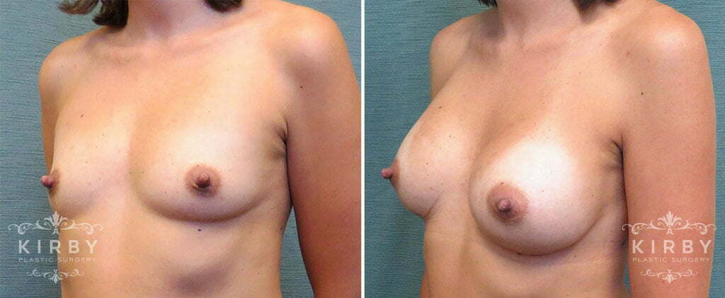 breast-augmentation-50b-left-kirby