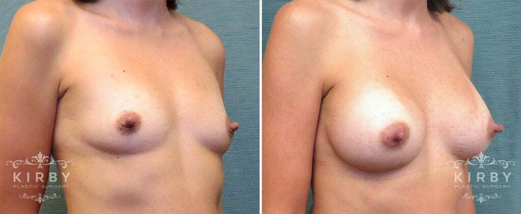 breast-augmentation-50b-right-kirby