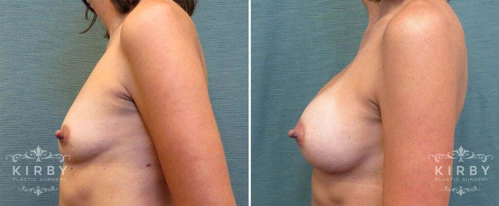 breast-augmentation-50c-left-kirby