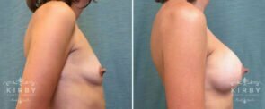 breast-augmentation-50c-right-kirby