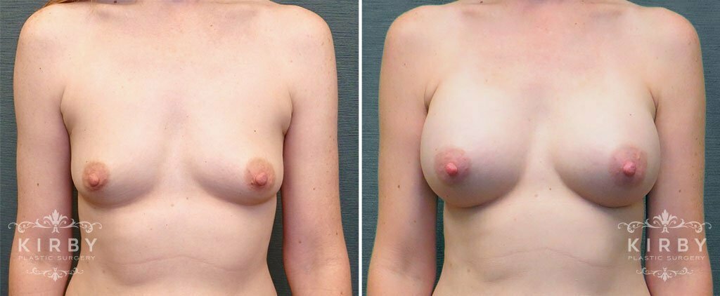Breast Augmentation G1134