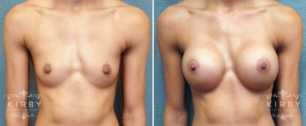Breast Augmentation G1149