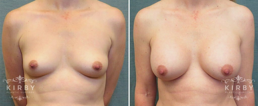 Breast Augmentation G148