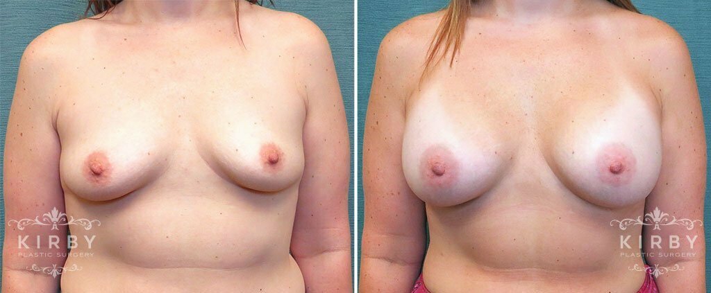 Breast Augmentation G177