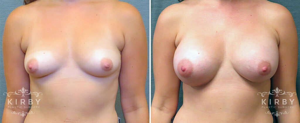 Breast Augmentation G191