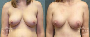 breast-lift-implants-mmo-88a-kirby