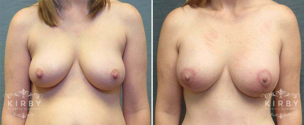 Breast Augmentation with Lift Patient G188