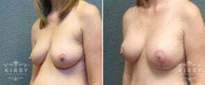 breast-lift-implants-mmo-88b-left-kirby