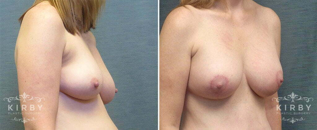 breast-lift-implants-mmo-88b-right-kirby