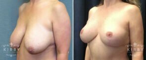 breast-lift-mmo-217b-left-kirby