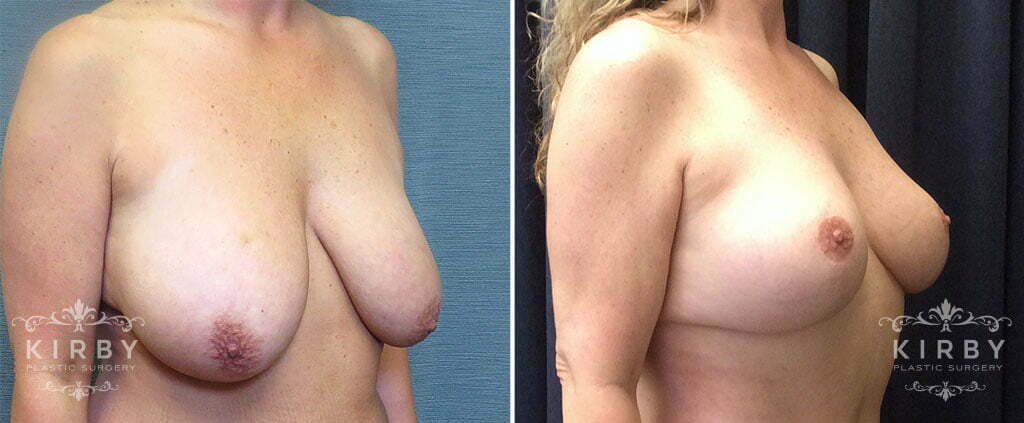 breast-lift-mmo-217b-right-kirby