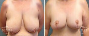 Breast Augmentation with Lift Patient G1192