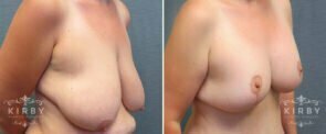 breast-lift-with-implants-mmo-192b-right-kirby