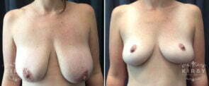 breast-reduction-mommy-makeover-405a-kirby