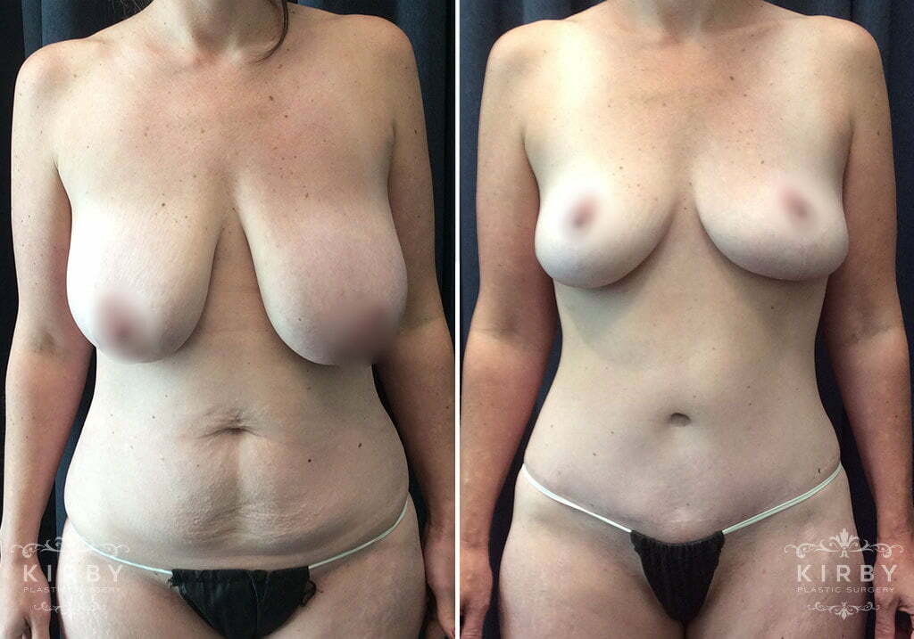 Dr. Kirby Mommy Makeover Before and After