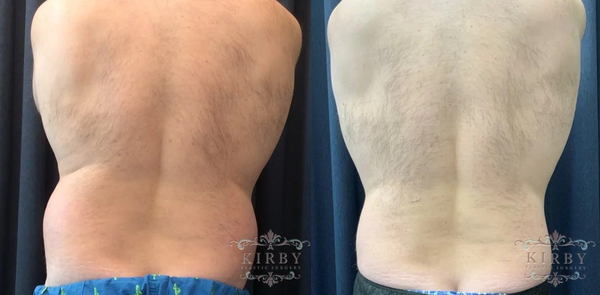 Liposuction Surgery