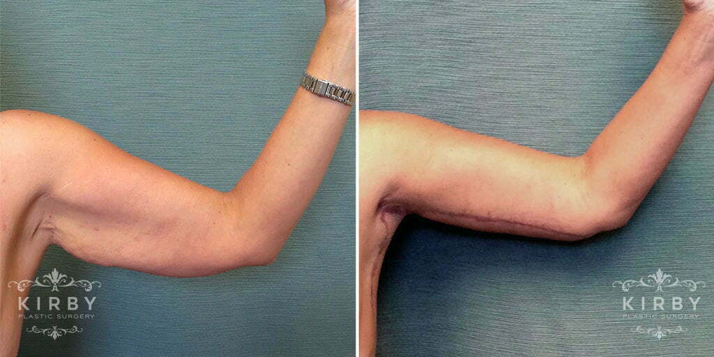 Patient's left arm before brachioplasty, with sagging skin or bat wings. The after photo shos a firmer and slimmer upper arm appearance with an incision scar located from elbow, through the underarm, down the side.