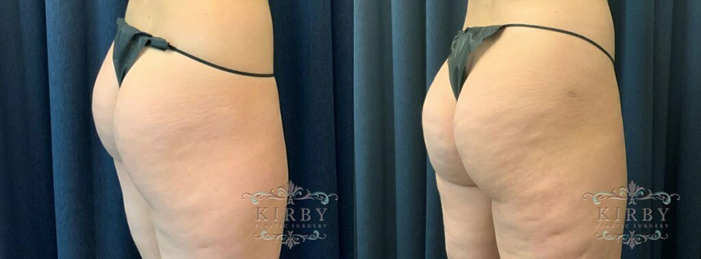 Brazilian Butt Lift G1702