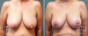 breast-lift-147a-kirby