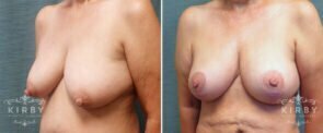 breast-lift-147b-left-kirby