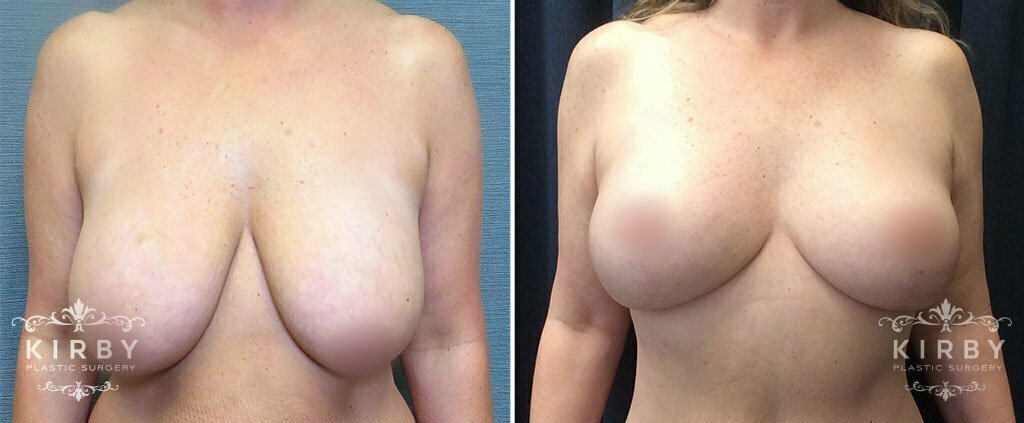 Breast Lift Before and After Patient by Dr. Emily Kirby