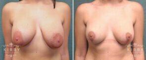 breast-lift-revision-56a-kirby
